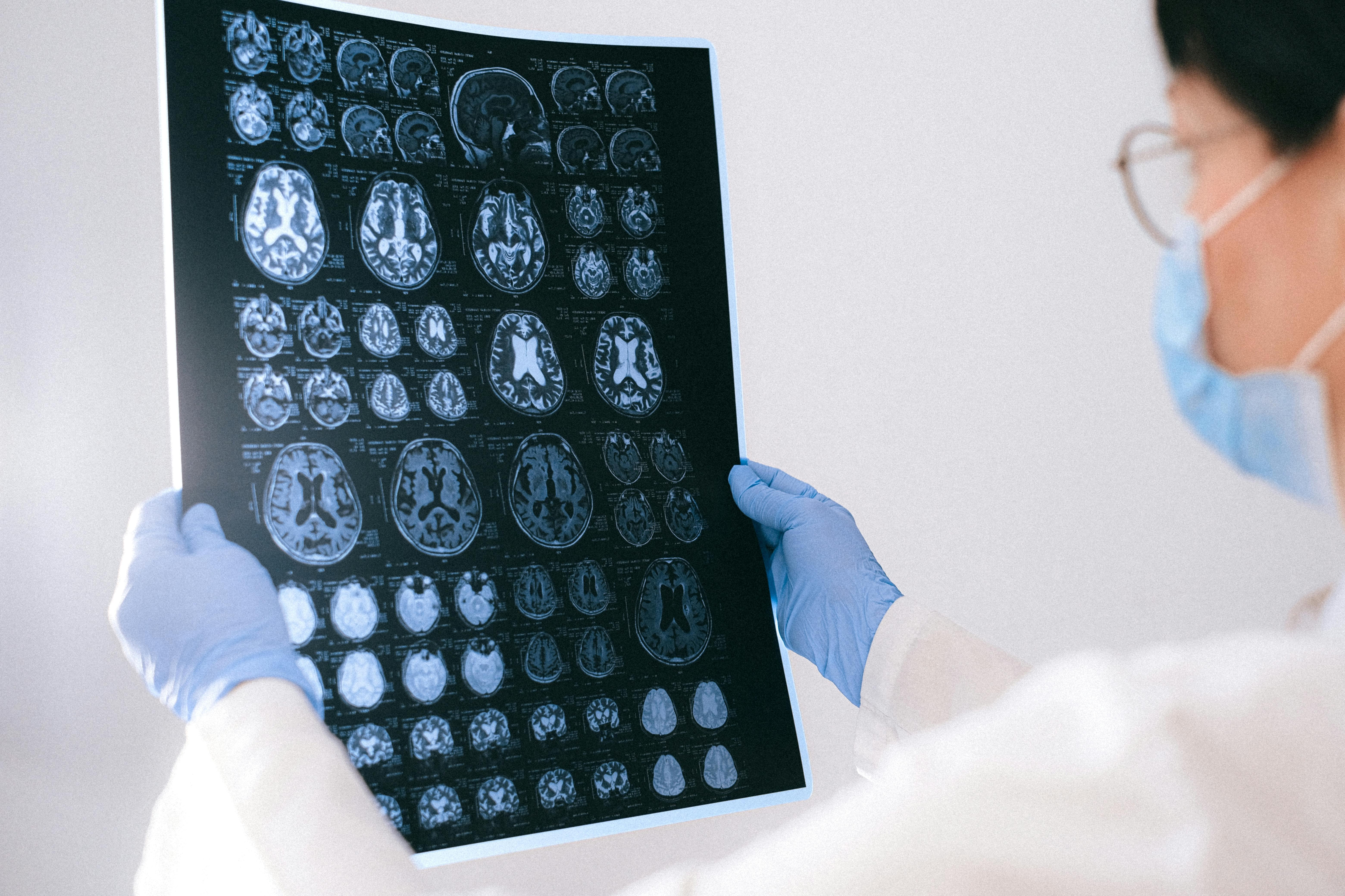 Identifican en sangre biomarcadores relevantes para diagnóstico y seguimiento de pacientes con epilepsia