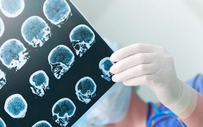 Por primera vez, buscaron identificar el riesgo genético de padecer Alzheimer en casi mil argentinos